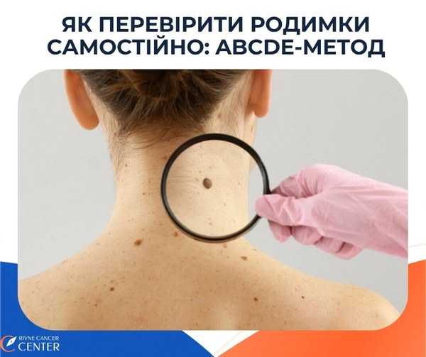 Правило АВСDЕ. Як перевірити родимки самостійно Правило АВСDЕ. Як перевірити родимки самостійно