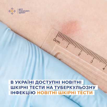 В Україні доступні новітні шкірні тести на туберкульозну інфекцію В Україні доступні новітні шкірні тести на туберкульозну інфекцію